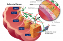Stages of colorectal cancer.