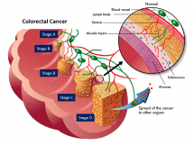 Stages of colorectal cancer.