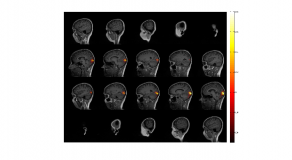 Brain-waves were localised to the occipital lobe of the brain, where visual information is processed